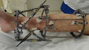 Космическая медицина: в ярославской больнице имени Соловьева научились выпрямлять неправильно сросшиеся кости ног